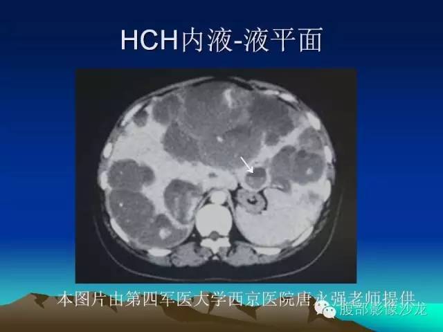 【PPT】不典型肝脏海绵状血管瘤影像诊断