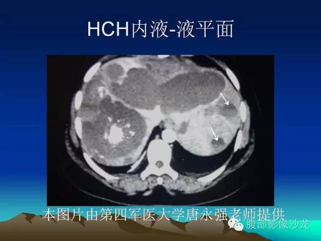 【PPT】不典型肝脏海绵状血管瘤影像诊断