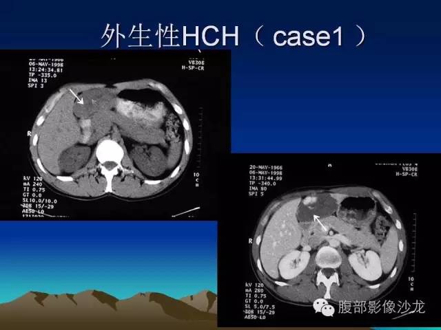 【PPT】不典型肝脏海绵状血管瘤影像诊断