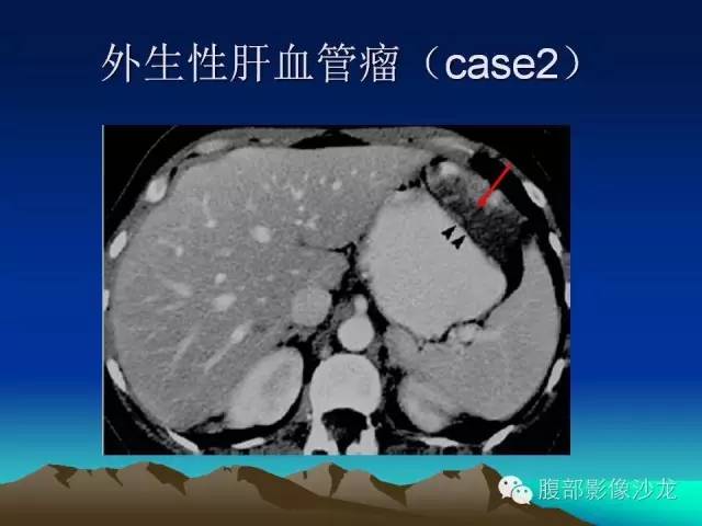 【PPT】不典型肝脏海绵状血管瘤影像诊断