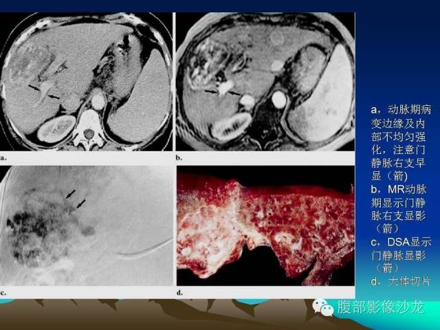 【PPT】不典型肝脏海绵状血管瘤影像诊断