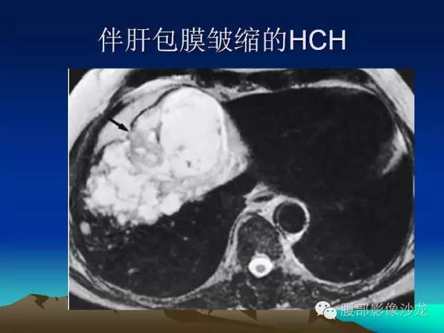 【PPT】不典型肝脏海绵状血管瘤影像诊断