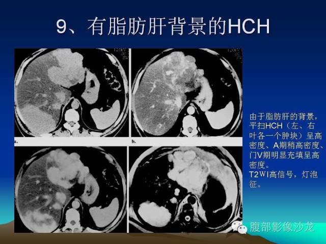 【PPT】不典型肝脏海绵状血管瘤影像诊断