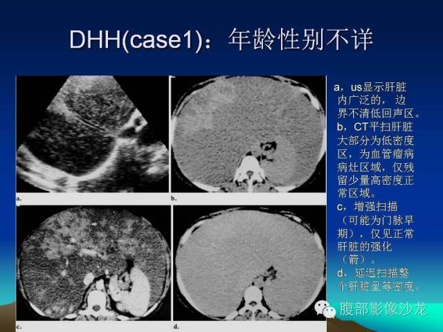 【PPT】不典型肝脏海绵状血管瘤影像诊断