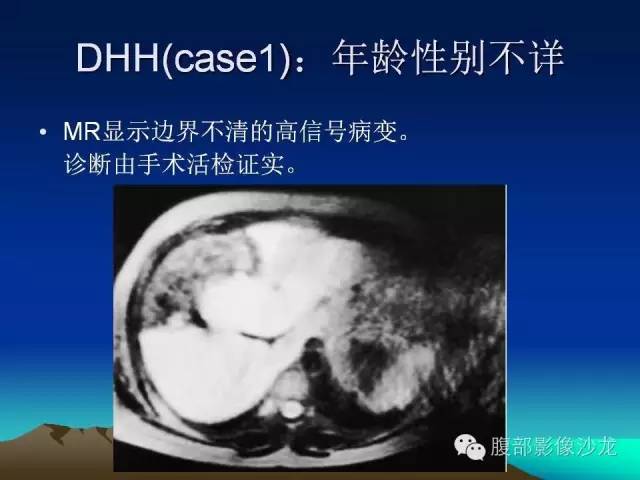 【PPT】不典型肝脏海绵状血管瘤影像诊断