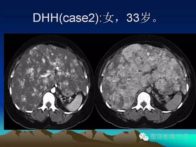 【PPT】不典型肝脏海绵状血管瘤影像诊断
