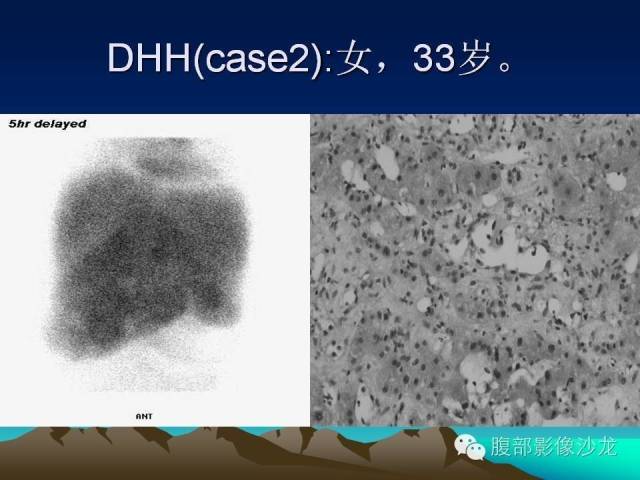 【PPT】不典型肝脏海绵状血管瘤影像诊断