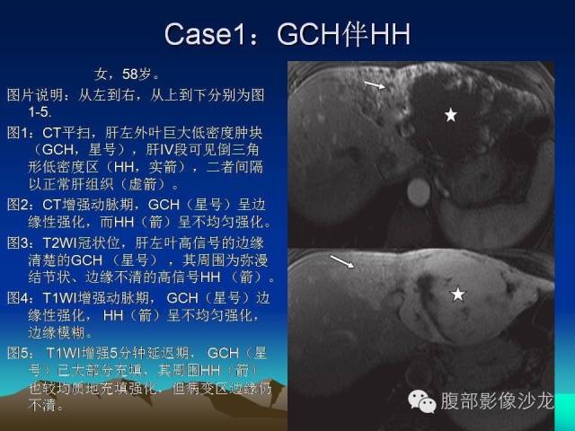 【PPT】不典型肝脏海绵状血管瘤影像诊断