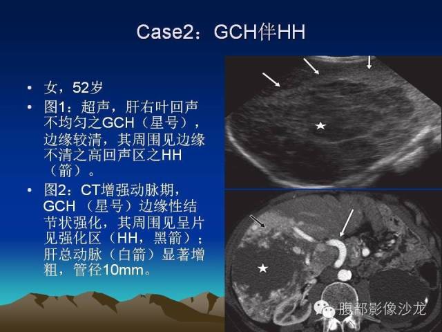 【PPT】不典型肝脏海绵状血管瘤影像诊断