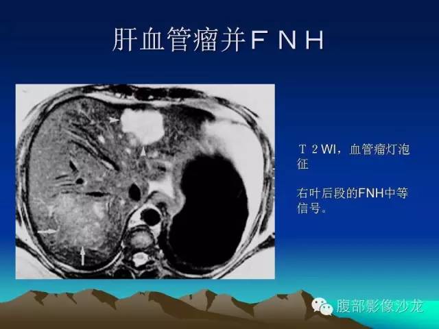 【PPT】不典型肝脏海绵状血管瘤影像诊断
