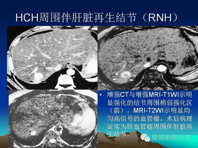 【PPT】不典型肝脏海绵状血管瘤影像诊断