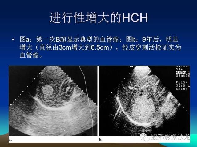 【PPT】不典型肝脏海绵状血管瘤影像诊断