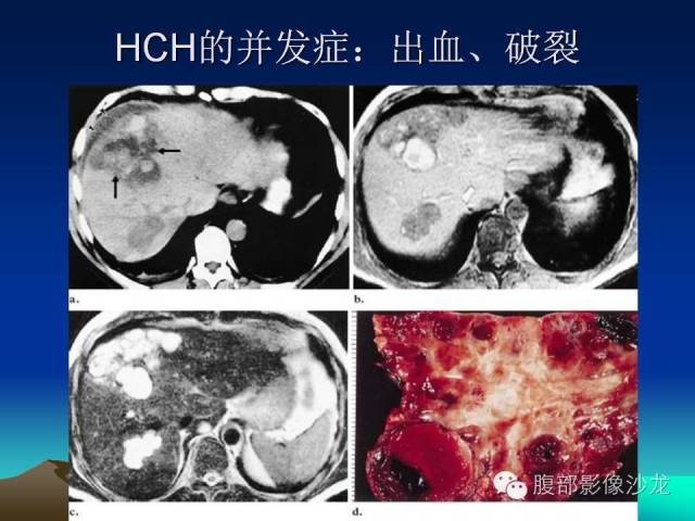 【PPT】不典型肝脏海绵状血管瘤影像诊断