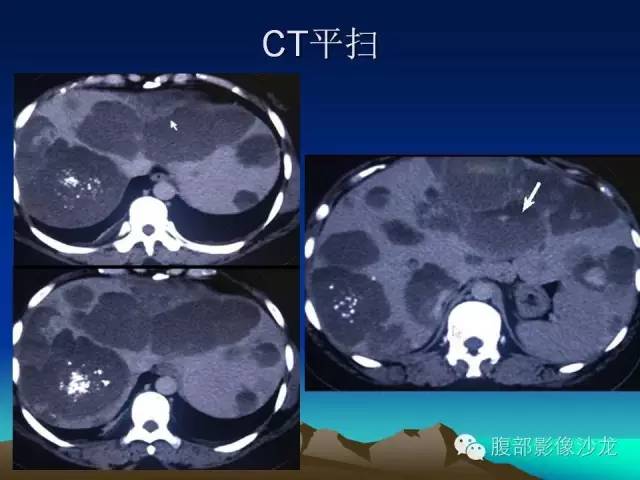 【PPT】不典型肝脏海绵状血管瘤影像诊断