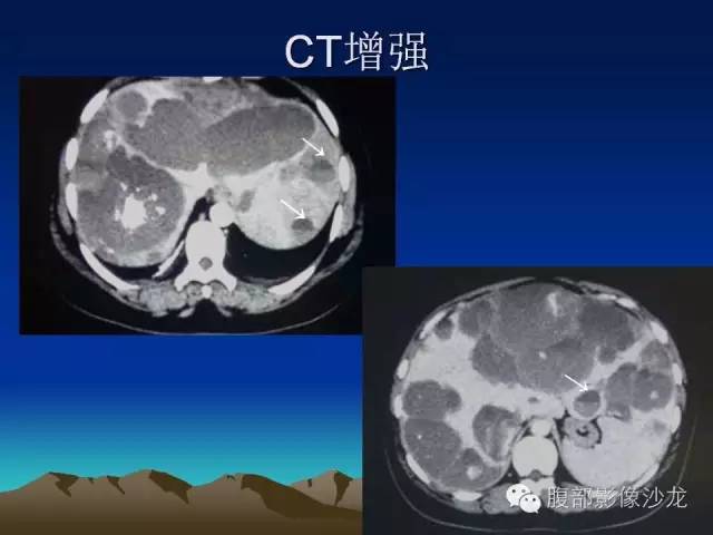 【PPT】不典型肝脏海绵状血管瘤影像诊断