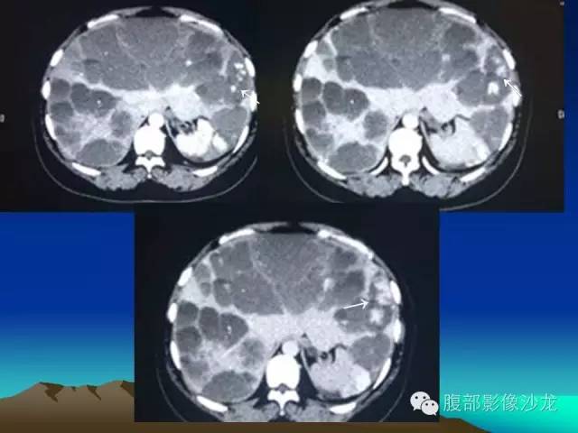 【PPT】不典型肝脏海绵状血管瘤影像诊断