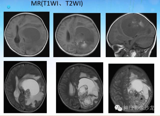 【PPT】外周原始神经外胚层肿瘤1例MR影像表现