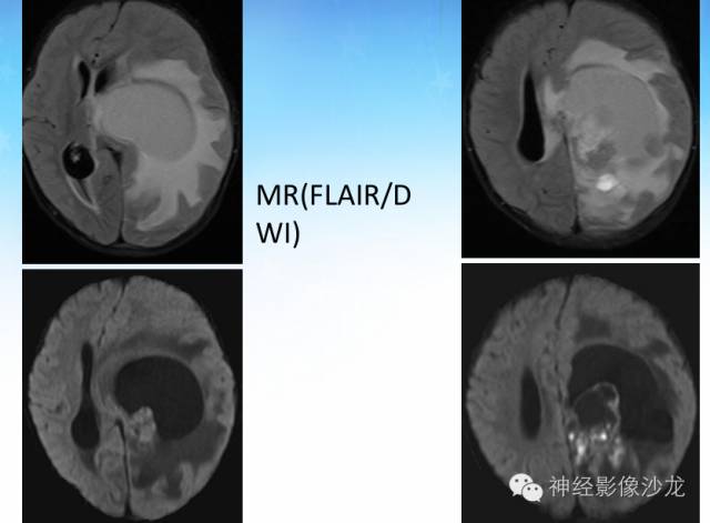 【PPT】外周原始神经外胚层肿瘤1例MR影像表现