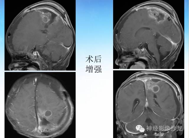 【PPT】外周原始神经外胚层肿瘤1例MR影像表现