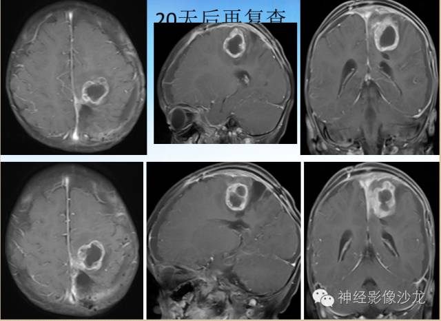 【PPT】外周原始神经外胚层肿瘤1例MR影像表现