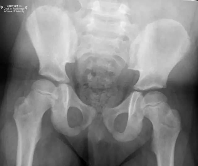 【病例】Legg-Calve-Perthes病1例X线影像表现