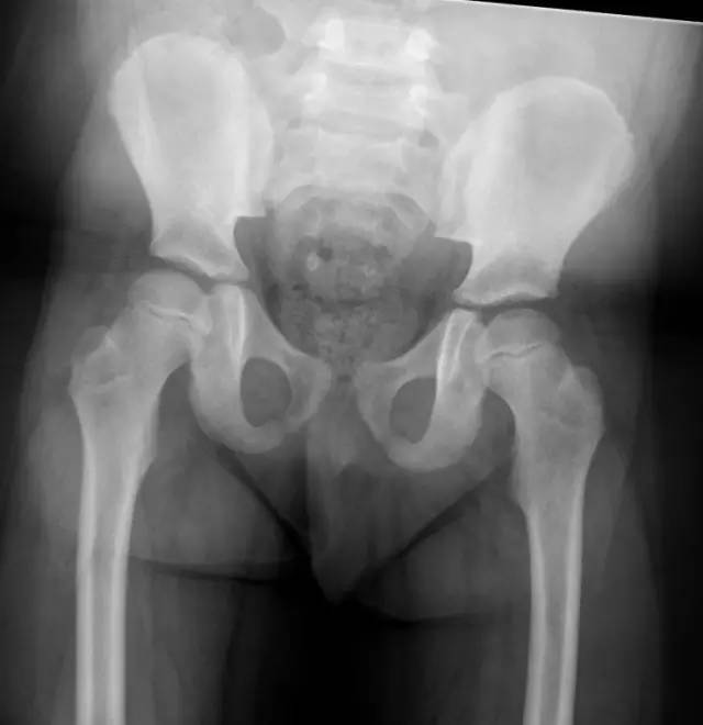 【病例】Legg-Calve-Perthes病1例X线影像表现