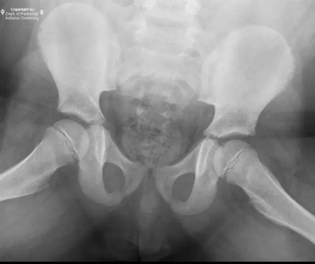 【病例】Legg-Calve-Perthes病1例X线影像表现