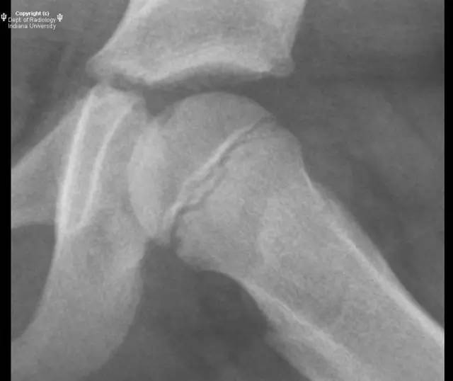 【病例】Legg-Calve-Perthes病1例X线影像表现