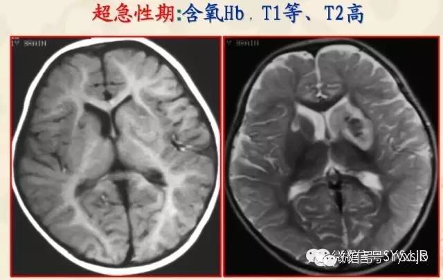 脑内血肿分期与MR信号变化特点 脑内血肿分期与MR信号变化特点