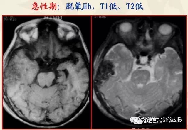 脑内血肿分期与MR信号变化特点 脑内血肿分期与MR信号变化特点