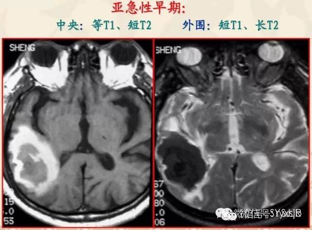 脑内血肿分期与MR信号变化特点 脑内血肿分期与MR信号变化特点