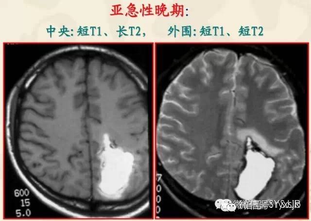 脑内血肿分期与MR信号变化特点 脑内血肿分期与MR信号变化特点