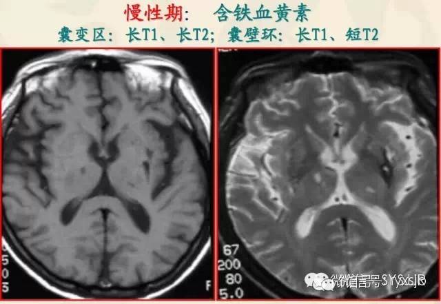 脑内血肿分期与MR信号变化特点 脑内血肿分期与MR信号变化特点