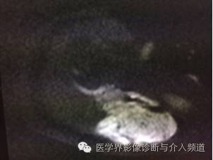 【病例】右肩部韧带样纤维瘤1例MR影像表现 【病例】右肩部韧带样纤维瘤1例MR影像表现