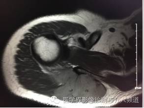 【病例】右肩部韧带样纤维瘤1例MR影像表现 【病例】右肩部韧带样纤维瘤1例MR影像表现