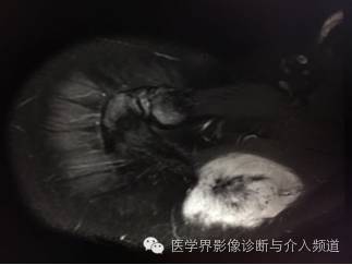 【病例】右肩部韧带样纤维瘤1例MR影像表现 【病例】右肩部韧带样纤维瘤1例MR影像表现