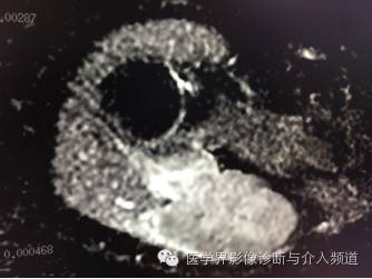【病例】右肩部韧带样纤维瘤1例MR影像表现 【病例】右肩部韧带样纤维瘤1例MR影像表现
