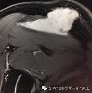 【病例】右肩部韧带样纤维瘤1例MR影像表现 【病例】右肩部韧带样纤维瘤1例MR影像表现
