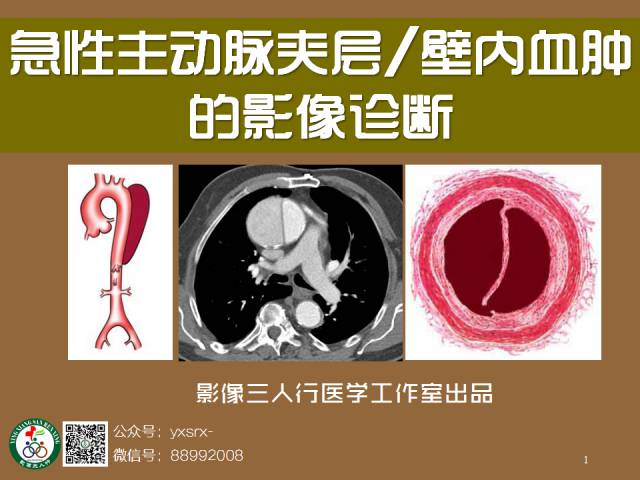 【PPT】急性主动脉夹层/壁内血肿的影像诊断
