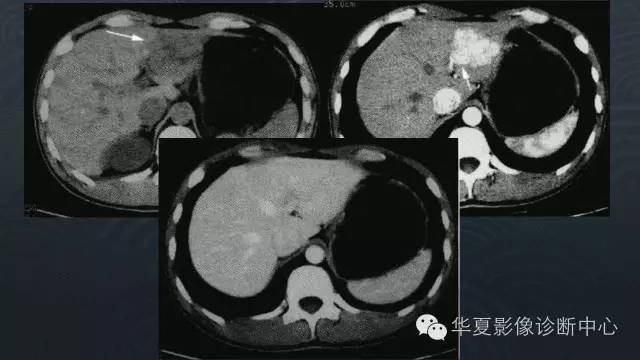 【PPT】肝脏局灶性结节增生FNH和腺瘤的影像诊断