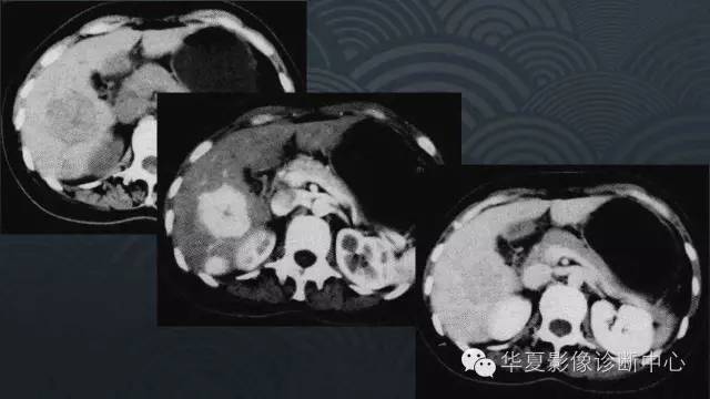 【PPT】肝脏局灶性结节增生FNH和腺瘤的影像诊断