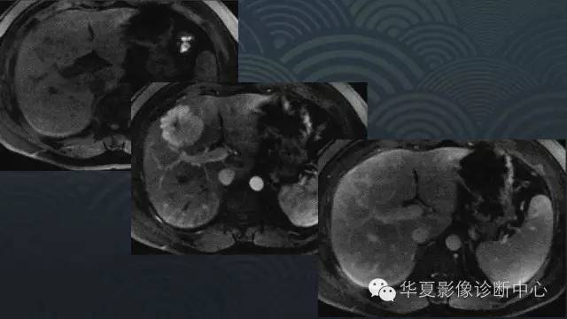 【PPT】肝脏局灶性结节增生FNH和腺瘤的影像诊断