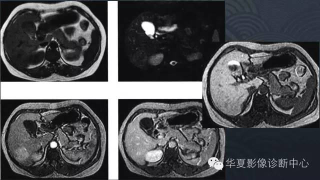 【PPT】肝脏局灶性结节增生FNH和腺瘤的影像诊断