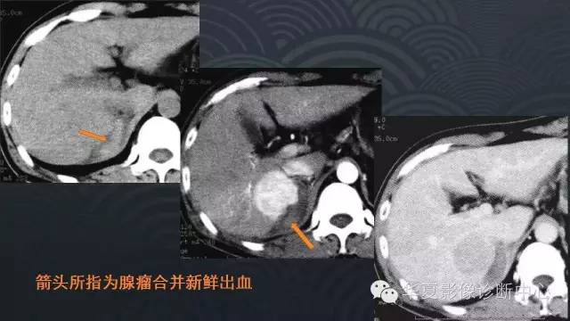 【PPT】肝脏局灶性结节增生FNH和腺瘤的影像诊断