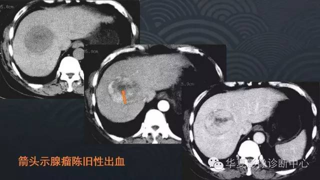 【PPT】肝脏局灶性结节增生FNH和腺瘤的影像诊断