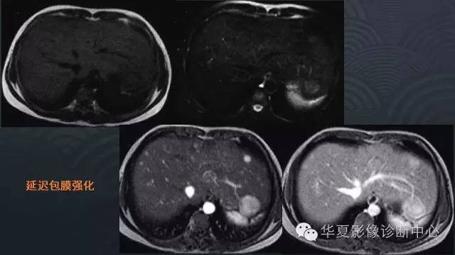 【PPT】肝脏局灶性结节增生FNH和腺瘤的影像诊断