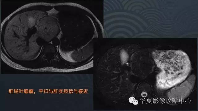 【PPT】肝脏局灶性结节增生FNH和腺瘤的影像诊断