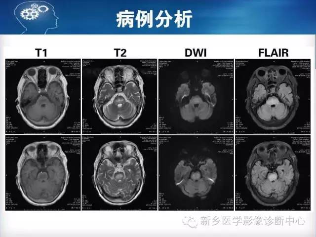 【病例】脑桥中央髓鞘溶解症1例MR影像表现