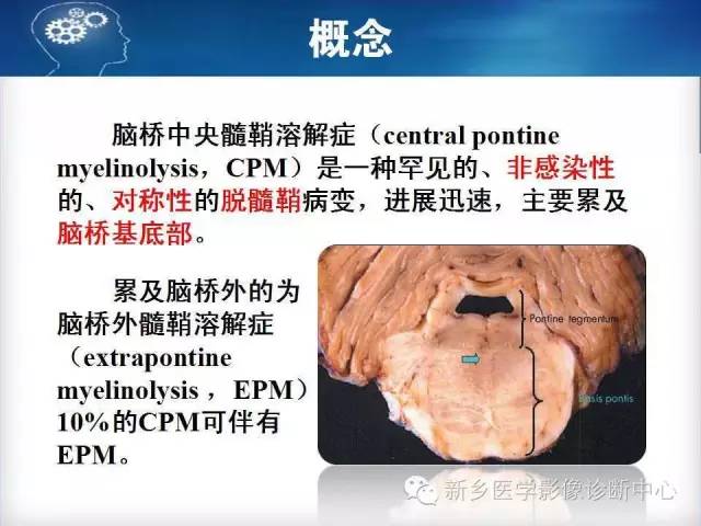 【病例】脑桥中央髓鞘溶解症1例MR影像表现