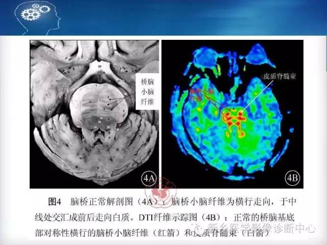 【病例】脑桥中央髓鞘溶解症1例MR影像表现